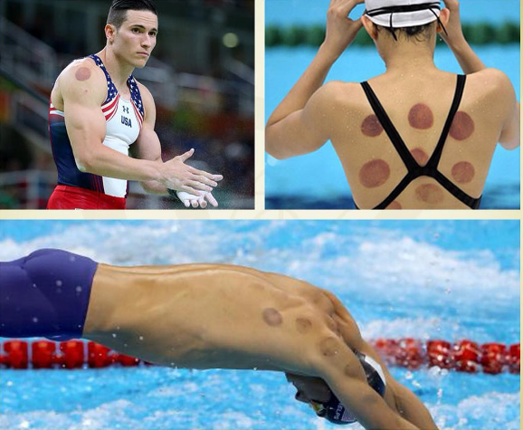 Get your Olympic stripes … er … spots: Where to get cupping in Brooklyn, and how much it costs